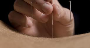 Acupunctura