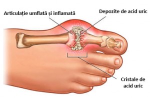 alimente-prevenire-guta