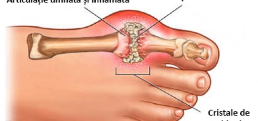 articulații de tratare a semințelor de in simptome de artrită la genunchi