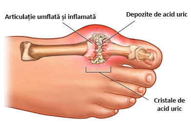 tratamentul nervilor genunchiului edem în articulațiile genunchiului cu artrită