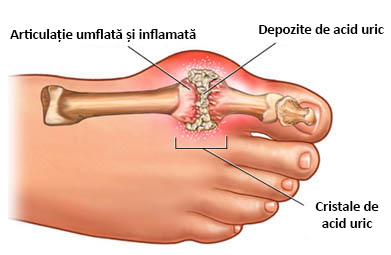 durerile de dinți în articulația umărului poate răni articulațiile de la nivelul coloanei vertebrale