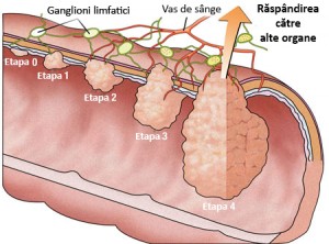 remedii-cancer-colon