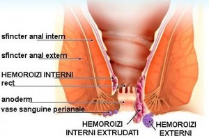 remedii-hemoroizi