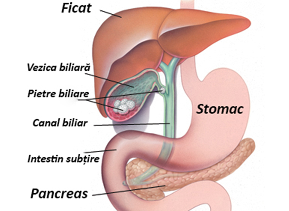 Litiaza biliara | microinjectie.ro