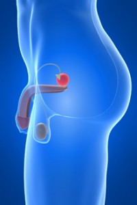 remedii-cancer-prostata